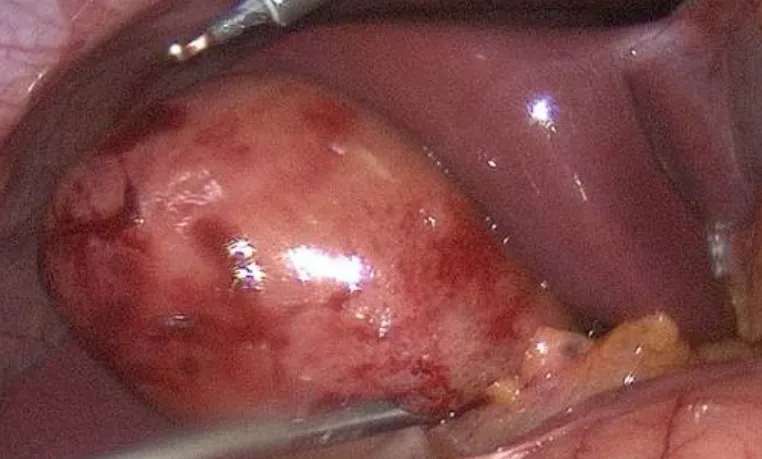 Acute Cholecystitis