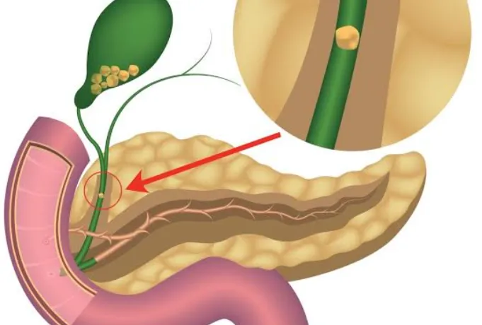 Bile Duct Stones