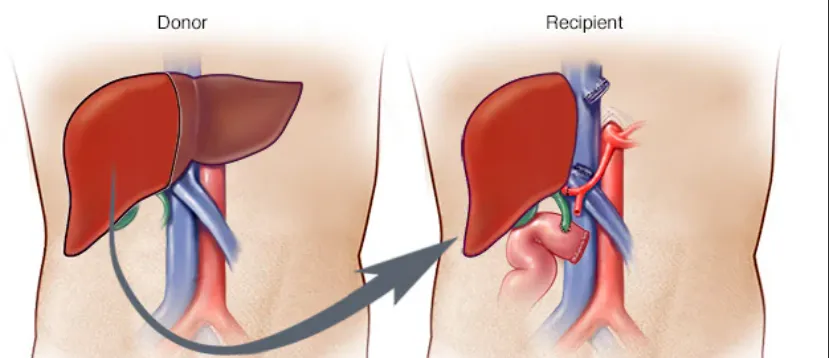 Liver Transplantation