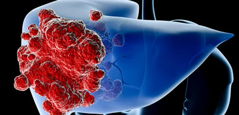 Liver Tumors & Liver Cancer