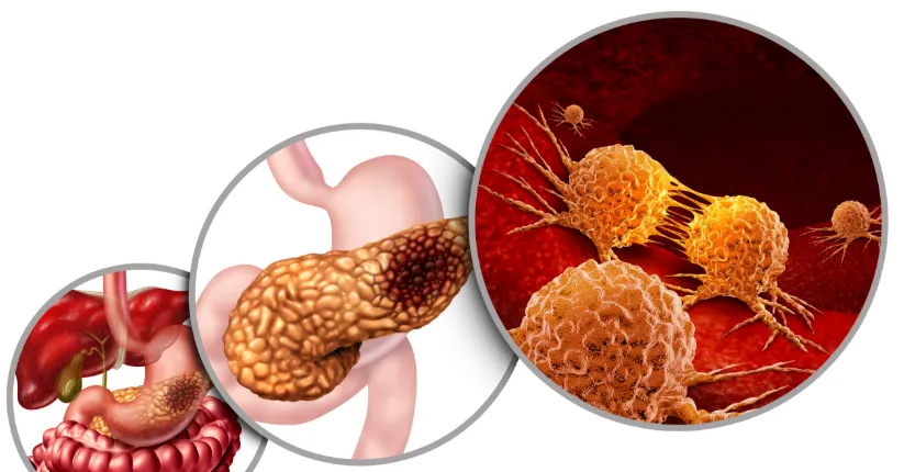 Pancreatic Cancer