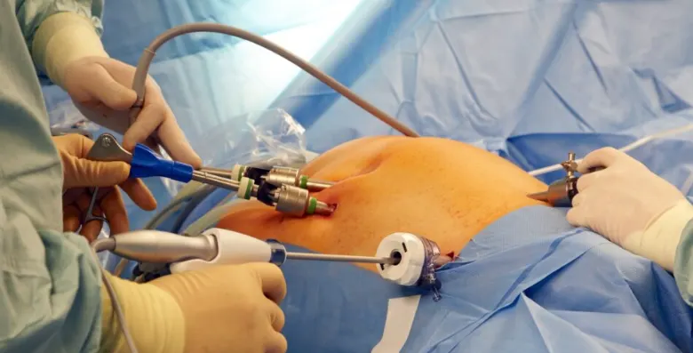 Laparoscopic (Keyhole) Surgery